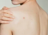 Hormonstörungen und Hautzustand